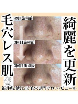 ピュール 鯖江店(PUR)/毛穴/毛穴ケア/毛穴洗浄