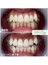 ホワイトニングサロン 名古屋駅店/【ホワイトニング施術例】