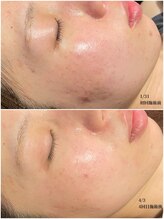 桜/エクソソームハーブピーリング