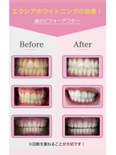 エクシア ホワイトニング 鶴岡店/ビフォーアフター