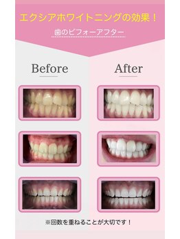 エクシア ホワイトニング 鶴岡店/ビフォーアフター