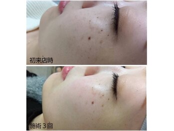 ハクア(HAQUA)/シミケア/フェイシャル/三ノ宮