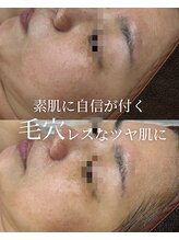 ココリール/くすみ　シミ