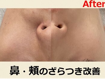 ゴールデンケア 岡崎店(Golden Care)/シミ・毛穴洗浄・フェイシャル