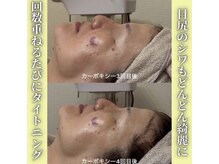 ハニエル(Haniel)/カーボキシー症例