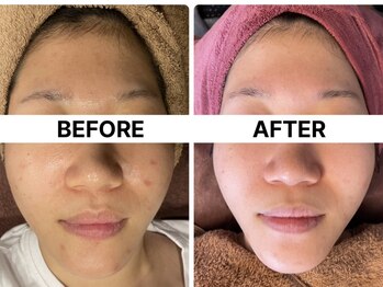 ハーブピーリング 恵比寿/ニキビケア/浮腫み/脂性肌