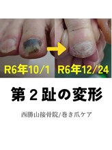 どうはく堂 西勝山接骨院/足の第２趾の変形