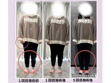 ルナ(Runa)/美容整体◆1回の効果&５回の効果