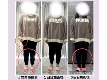 ルナ(Runa)/美容整体◆1回の効果&５回の効果