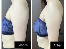 リーリア(LiLia)/二の腕スッキリ集中コース♪