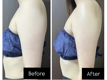 リーリア(LiLia)/二の腕スッキリ集中コース♪