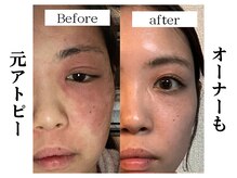 悩みさよなら。肌管理ハーブピーリングで肌質改善【箕面/大阪】