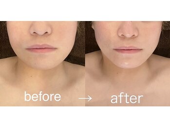 プール エドボリ(POOL EDOBORI)/小顔コルギ