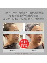 リュクシー(LuxeY)/高濃度ナノ幹細胞でたるみ改善