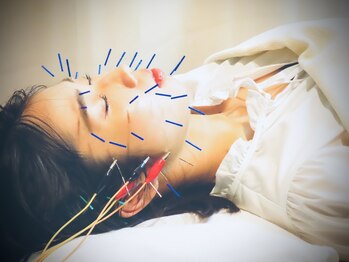 かわだ鍼灸整骨院の写真/【美容鍼＋パルス通電】　たっぷり40本で5,000円！2回目以降も同額！
