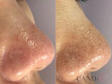キャンディ 名古屋金山店(CANDi)/ハイドラピーリング黒ずみ毛穴◎