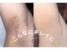 ［女性］人気No.1★お顔とVIO含む全身脱毛★全てのムダ毛を無くす！