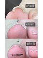 キャンディベース フクシマ(Candybase Fukushima)&nbsp;footケアが得意です！巻き爪でお悩みの方是非ご相談ください！