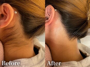 ラナ(Lana)/うなじW脱毛