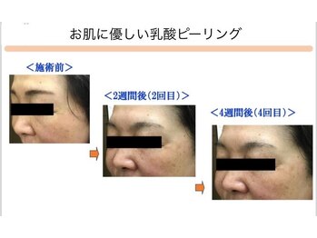 ベッラドンナ(Bella donna)/シワ、ハリケア BeforeAfter