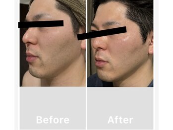 ブルーミントビューティー(blue mint Beauty)/メンズ小顔