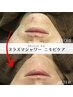 今だけ！男女【ニキビケア】肌質改善！11000円⇒体験2200円OFF！