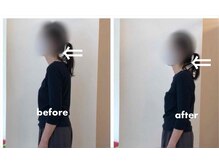 みらい整骨院/ストレートネックも改善しますよ