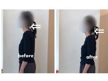 みらい整骨院/ストレートネックも改善しますよ