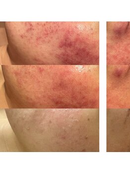 プルームドゥクレ(plume de cle')/つらい肌荒れに