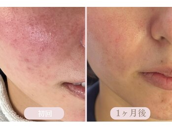 エピル(EPIL)/スキンケアセット症例