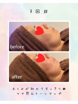 リリアン(lirien)/毛穴/毛穴ケア/毛穴洗浄/駒込