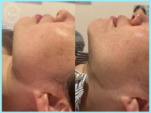 ハーブピーリング 名古屋/光ピールと併用でEライン激変