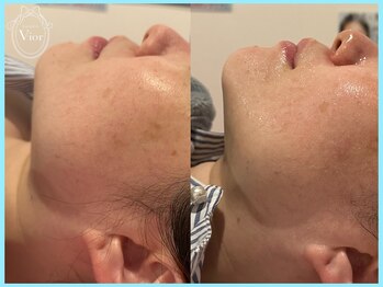 ハーブピーリング 名古屋/光ピールと併用でEライン激変