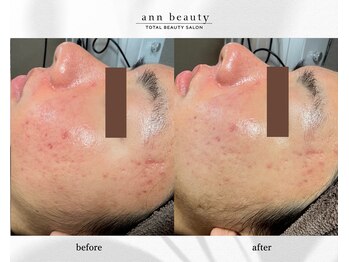 アン ビューティー(ann beauty)/施術1回【症例写真】10代
