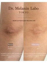 ドクターメラニン ラボ トーキョー 渋谷(Dr. Melanin Labo TOKYO)/肘メラニンケア症例