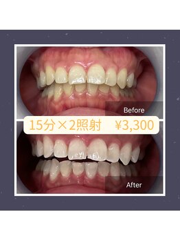 ベルプラス 新大阪(Belle plus)/沁みないホワイトニング！