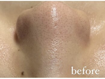 リリーブー 池袋(Lilyboo)/ハイドラフェイシャル