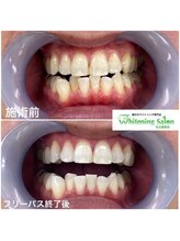 ホワイトニングサロン 名古屋駅店/【ホワイトニング施術例】