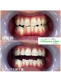 ホワイトニングサロン 名古屋駅店/【ホワイトニング施術例】