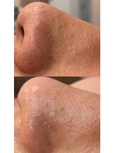 ディオーネ 春日井勝川店(Dione)/毛穴洗浄☆ビフォーアフター