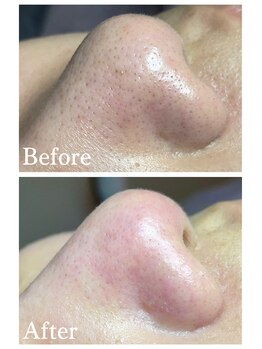 ジェンヌ(jenne.)/毛穴エクストラクション