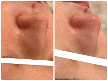 メゾンリュバン 梅田店(Maison Ruban)/毛穴洗浄｜毛穴ケア