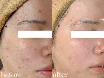 ホワイトアクア 北千住店(WHITE AQUA)/ハーブ+高濃度ビタミンc美容液☆