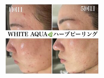 ホワイトアクア 加古川店(WHITE AQUA)/ハーブピーリング毛穴加古川