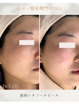 アトリア(ATRIA)/純粋レチノールピール
