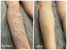 エリクサー 加須店(Elixir)/足脱毛6回照射ビフォーアフター!