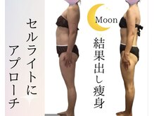 ムーン(MOON)/セルライトゼロで結果出し痩身