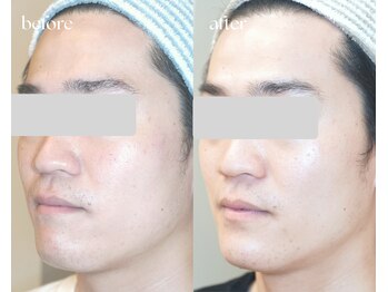 岩川治療院/ニキビ肌が改善へ 美容鍼