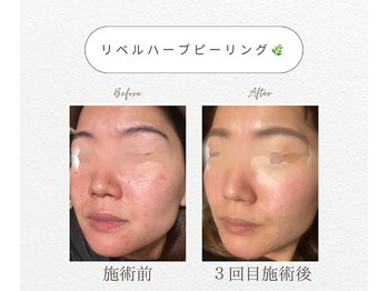ワイズビューティ(Y’s Beauty)/リベルハーブ★before &after