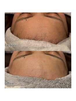 アデル 久留米(ADEL)/フェイシャルワックス《額》